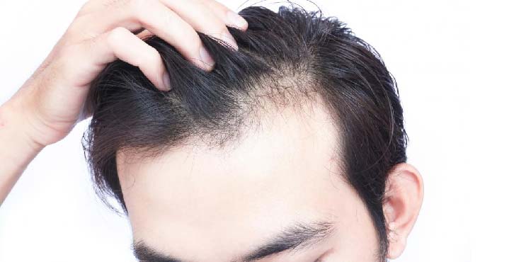 Hair Loss Treatments